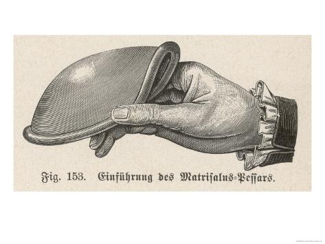 Diagram to Show How the Matrisalus Cap is Held for Inserting into the Vagina Diagram to Show How the Matrisalus Cap is Held for Inserting into the Vagina