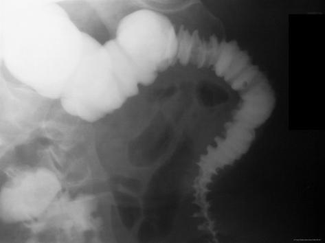 barium contrast