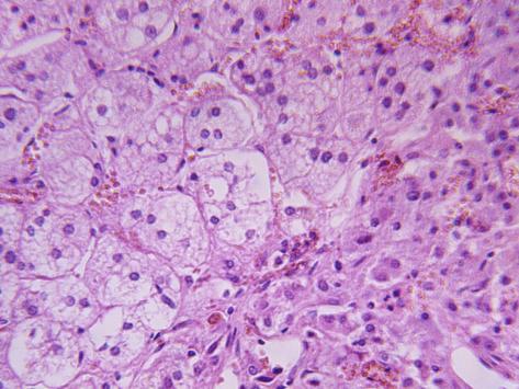 HIPERPLASIA SUPRARENAL hiperplasia suprarenal:
