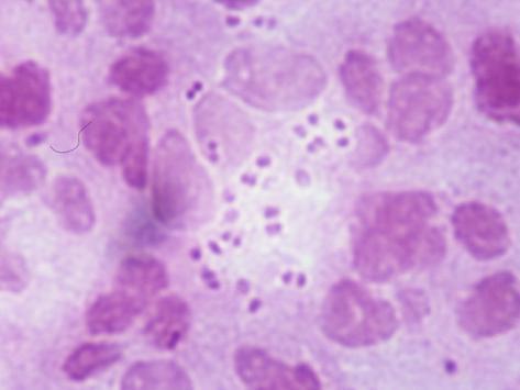 Gonorrhea Photos