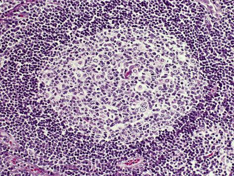 Lymph Node Zones