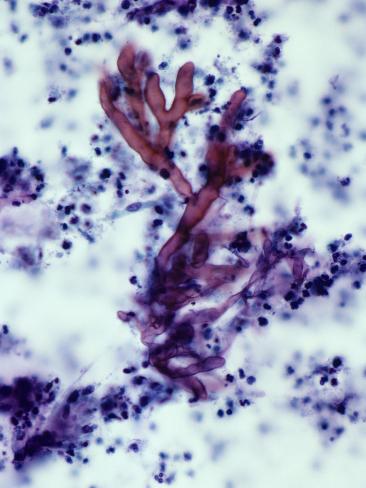 Aspergillus In Sputum