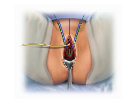 Female Perineal