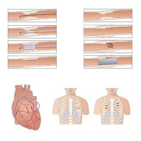 heart failure treatment
