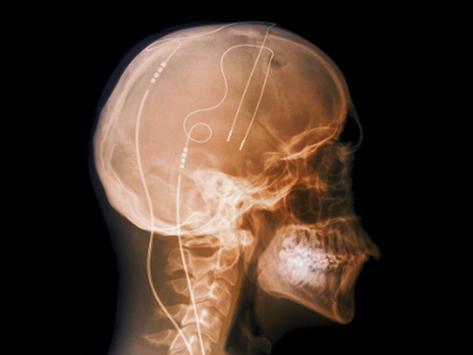 Tourette syndrome adults symptoms