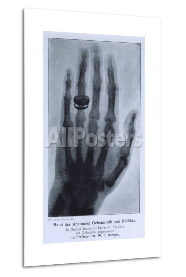 Konrad Roentgen S X Ray Of The Hand Of Showing Bones And The Ring 15 Photo Allposters Com