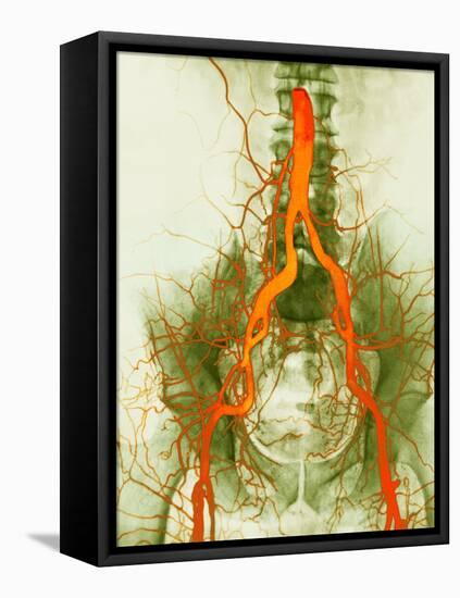 Abdominal Arteries, X-ray-null-Framed Stretched Canvas
