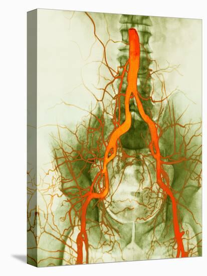 Abdominal Arteries, X-ray-null-Stretched Canvas