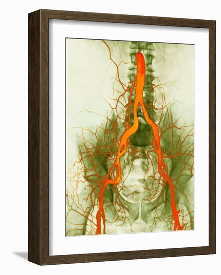 Abdominal Arteries, X-ray-null-Framed Photographic Print