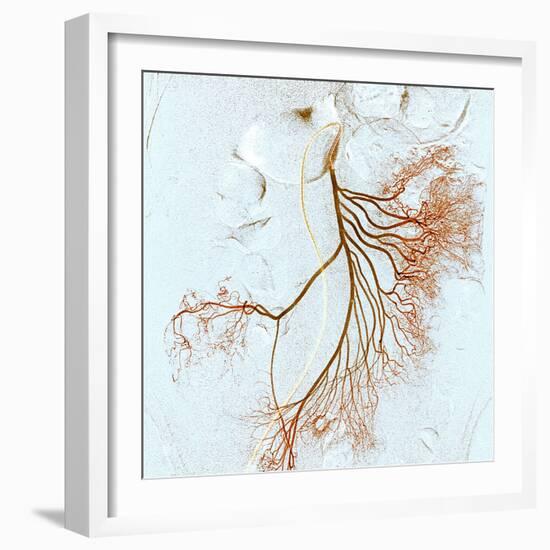 Abdominal Blood Vessels, X-ray-Du Cane Medical-Framed Premium Photographic Print