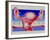 Abstract Artwork of Uterus, Pill & Menstrual Cycle-John Bavosi-Framed Photographic Print