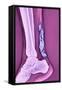 Achilles Tendinitis, X-ray-null-Framed Stretched Canvas