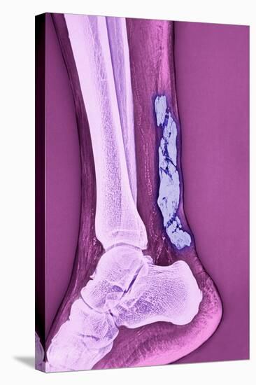 Achilles Tendinitis, X-ray-null-Stretched Canvas
