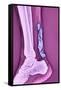 Achilles Tendinitis, X-ray-null-Framed Stretched Canvas