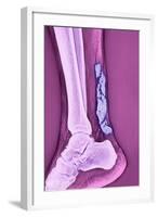 Achilles Tendinitis, X-ray-null-Framed Premium Photographic Print