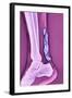 Achilles Tendinitis, X-ray-null-Framed Premium Photographic Print