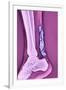 Achilles Tendinitis, X-ray-null-Framed Photographic Print