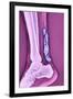 Achilles Tendinitis, X-ray-null-Framed Photographic Print