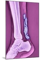 Achilles Tendinitis, X-ray-null-Mounted Photographic Print