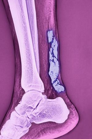 https://imgc.allpostersimages.com/img/posters/achilles-tendinitis-x-ray_u-L-PZIEGC0.jpg?artPerspective=n
