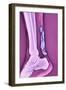 Achilles Tendinitis, X-ray-null-Framed Photographic Print