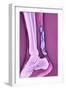 Achilles Tendinitis, X-ray-null-Framed Photographic Print