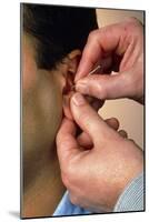 Acupuncturist's Hands Insert Needle Into Man's Ear-Damien Lovegrove-Mounted Photographic Print