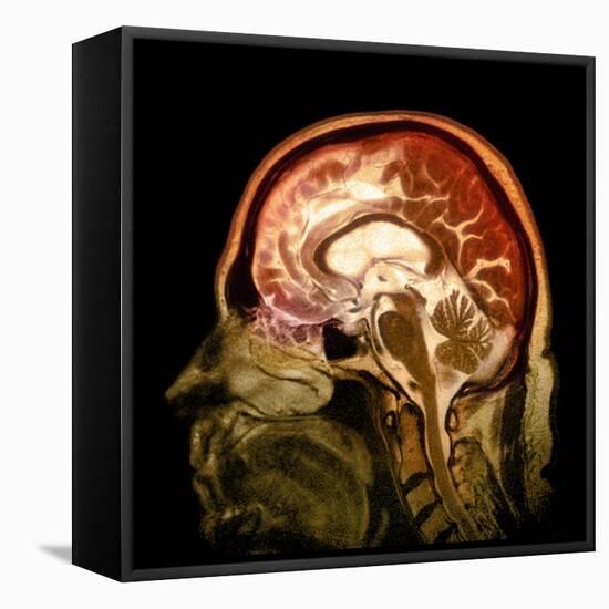 Alcoholic Dementia, MRI Scan-Du Cane Medical-Framed Stretched Canvas
