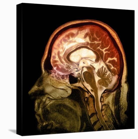 Alcoholic Dementia, MRI Scan-Du Cane Medical-Stretched Canvas