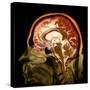 Alcoholic Dementia, MRI Scan-Du Cane Medical-Stretched Canvas