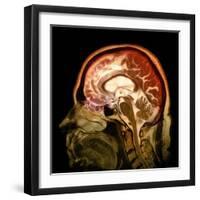 Alcoholic Dementia, MRI Scan-Du Cane Medical-Framed Premium Photographic Print