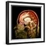 Alcoholic Dementia, MRI Scan-Du Cane Medical-Framed Premium Photographic Print