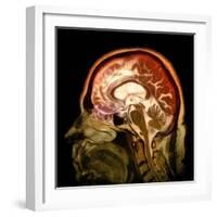 Alcoholic Dementia, MRI Scan-Du Cane Medical-Framed Premium Photographic Print