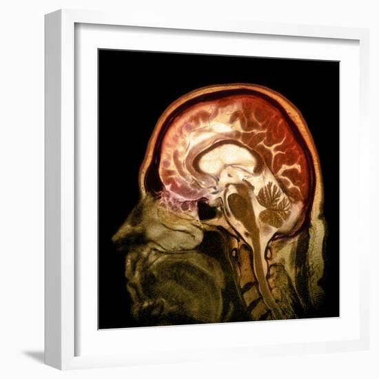 Alcoholic Dementia, MRI Scan-Du Cane Medical-Framed Premium Photographic Print