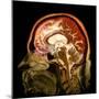 Alcoholic Dementia, MRI Scan-Du Cane Medical-Mounted Premium Photographic Print