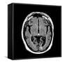 Alcoholic Dementia, MRI Scan-Du Cane Medical-Framed Stretched Canvas