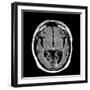 Alcoholic Dementia, MRI Scan-Du Cane Medical-Framed Photographic Print