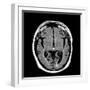 Alcoholic Dementia, MRI Scan-Du Cane Medical-Framed Photographic Print