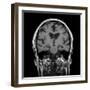 Alcoholic Dementia, MRI Scan-Du Cane Medical-Framed Photographic Print