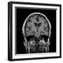 Alcoholic Dementia, MRI Scan-Du Cane Medical-Framed Photographic Print
