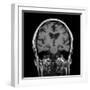 Alcoholic Dementia, MRI Scan-Du Cane Medical-Framed Photographic Print