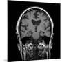 Alcoholic Dementia, MRI Scan-Du Cane Medical-Mounted Photographic Print