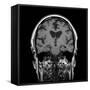 Alcoholic Dementia, MRI Scan-Du Cane Medical-Framed Stretched Canvas