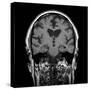 Alcoholic Dementia, MRI Scan-Du Cane Medical-Stretched Canvas