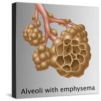 Alveoli with Emphysema-Gwen Shockey-Stretched Canvas