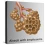 Alveoli with Emphysema-Gwen Shockey-Stretched Canvas