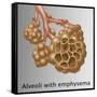 Alveoli with Emphysema-Gwen Shockey-Framed Stretched Canvas