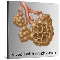 Alveoli with Emphysema-Gwen Shockey-Stretched Canvas