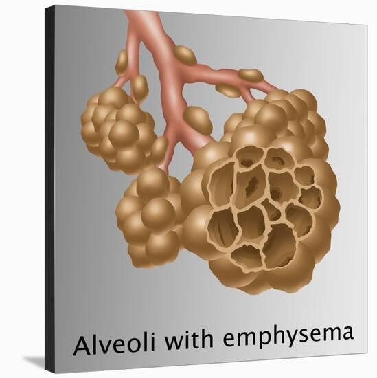 Alveoli with Emphysema-Gwen Shockey-Stretched Canvas