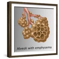 Alveoli with Emphysema-Gwen Shockey-Framed Giclee Print